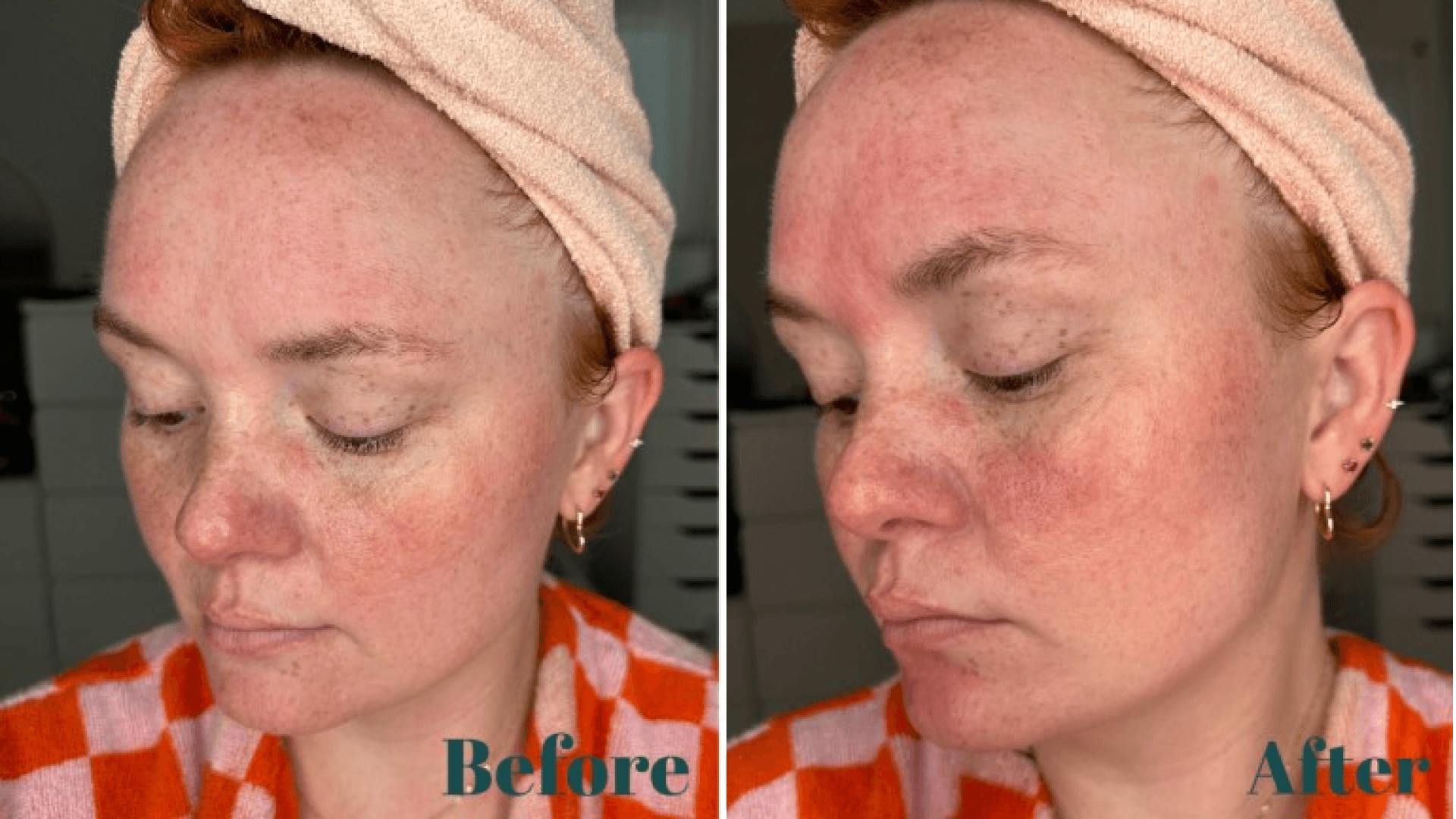 Dermaflash Before and After