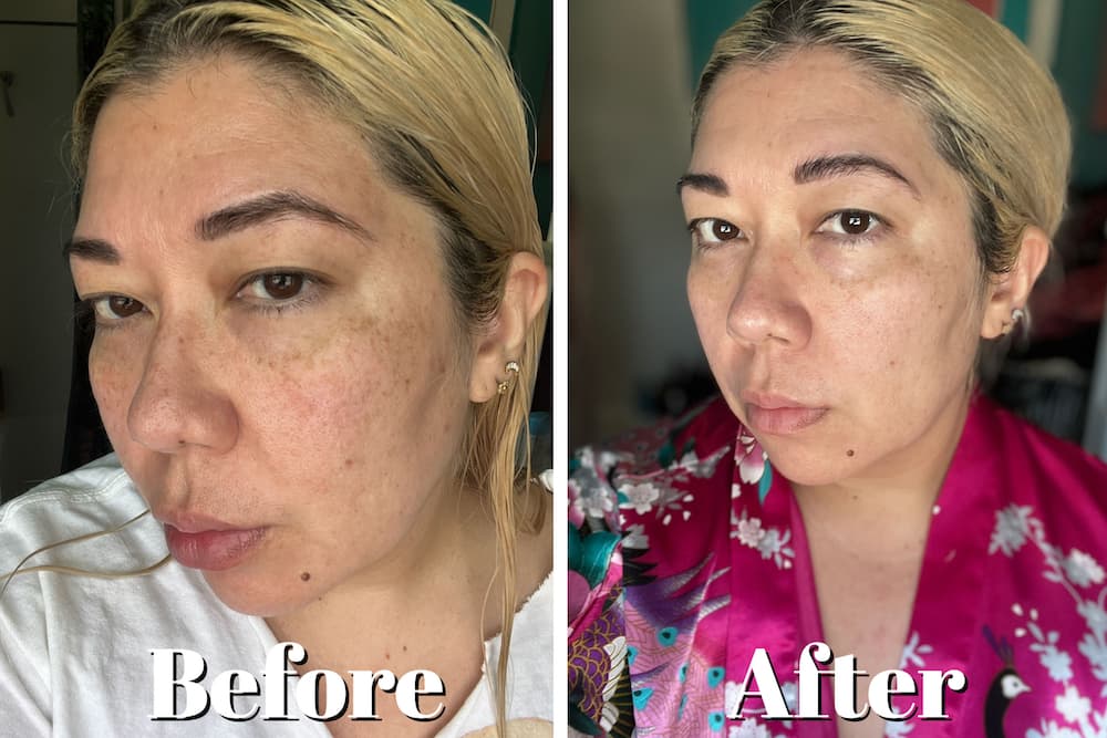 before after alastin