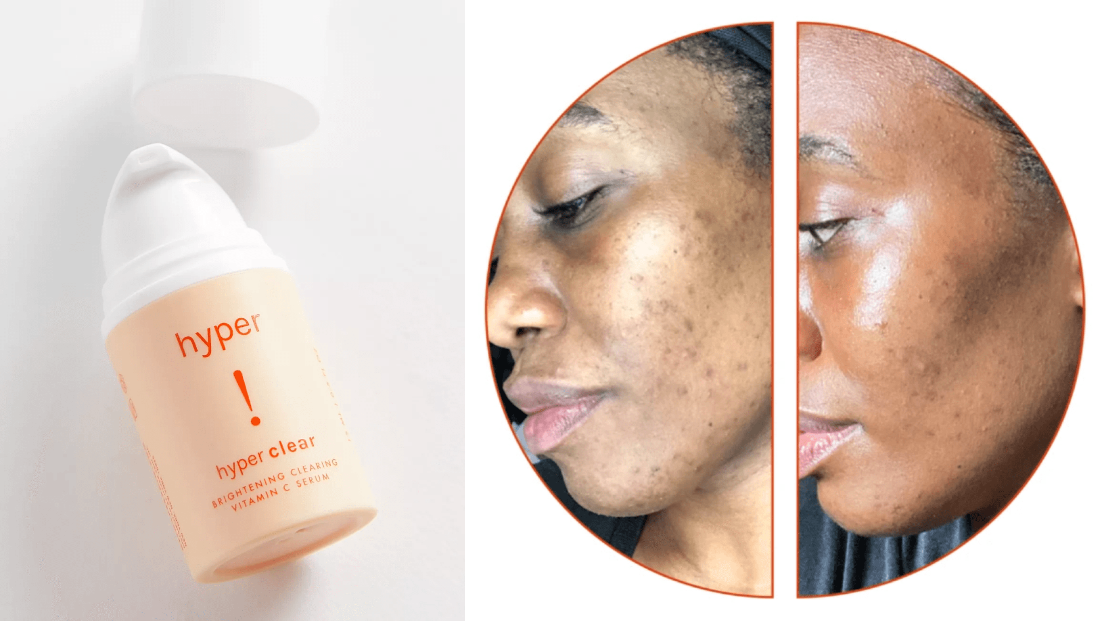 brightening vitamin c serum for dark spots, acne scars, and sun spots