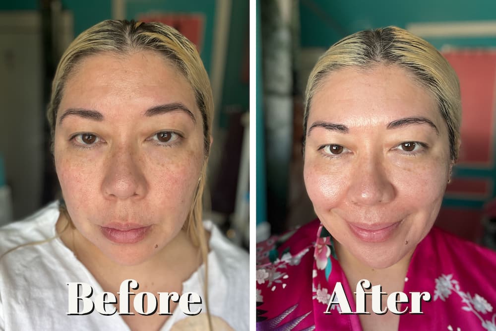 before after alastin