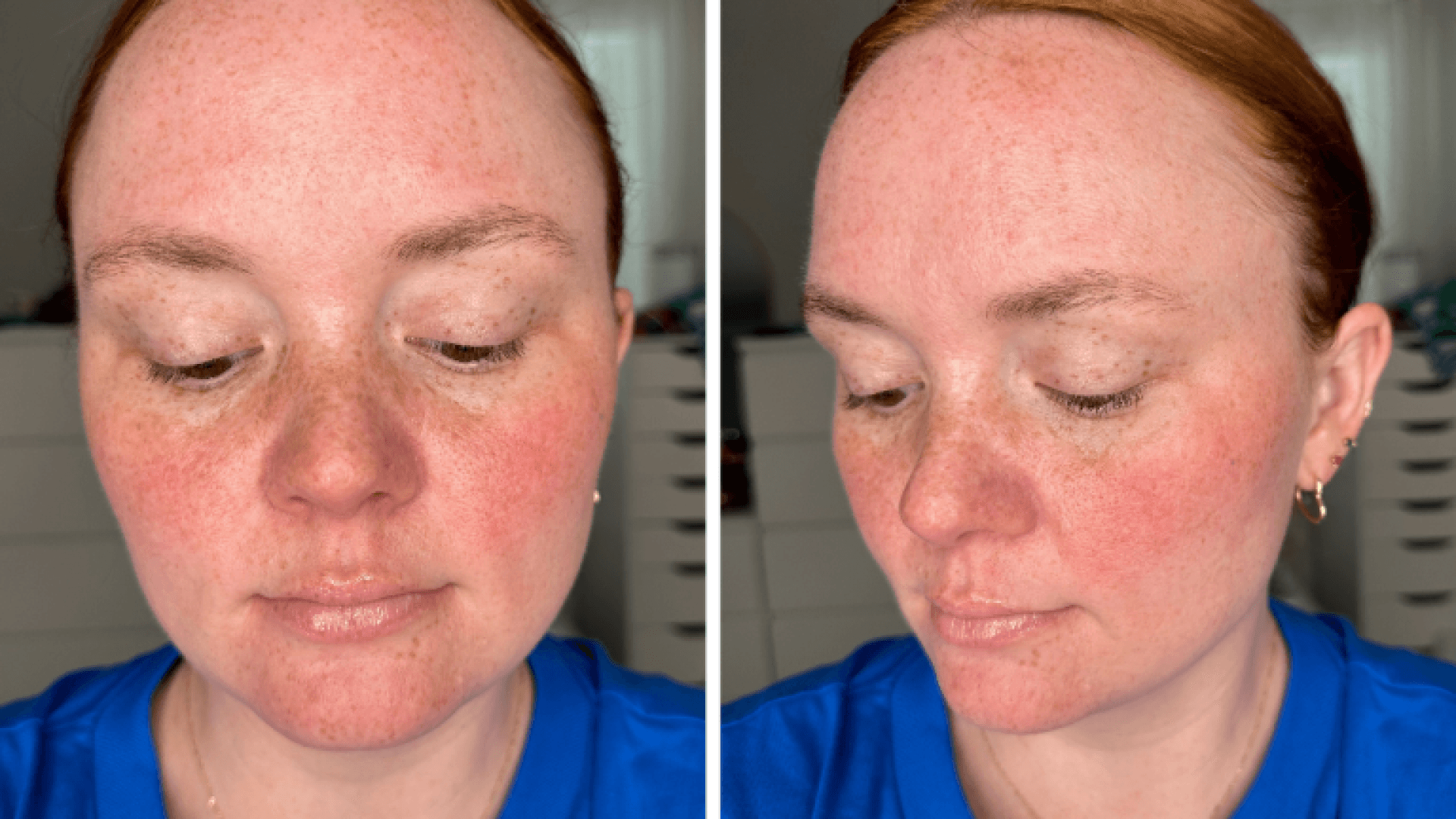 Dermaflash Results