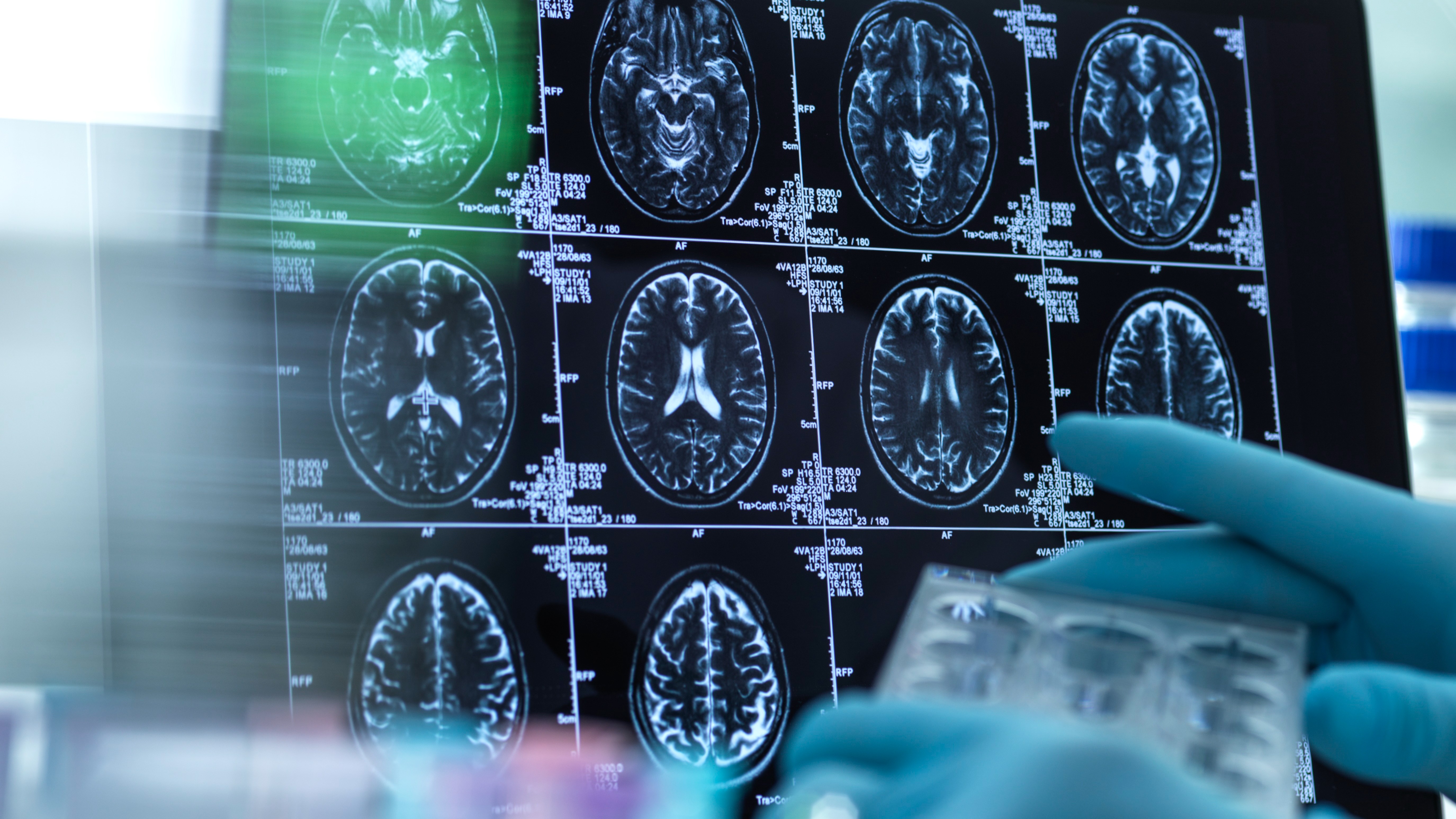 Neurology research, conceptual image. Scientist preparing a multi well plate in front of brain scans.